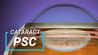 Cataract_Post_Sub_C