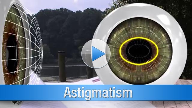 Lasik Astigmatism Astigmatism Chicago Astigmatism Treatment - 